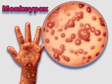 Understanding Monkeypox (Mpox) and How to Protect Yourself